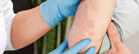 Psoriazis – cauze, simptome și managementul eficient al acestei afecțiuni